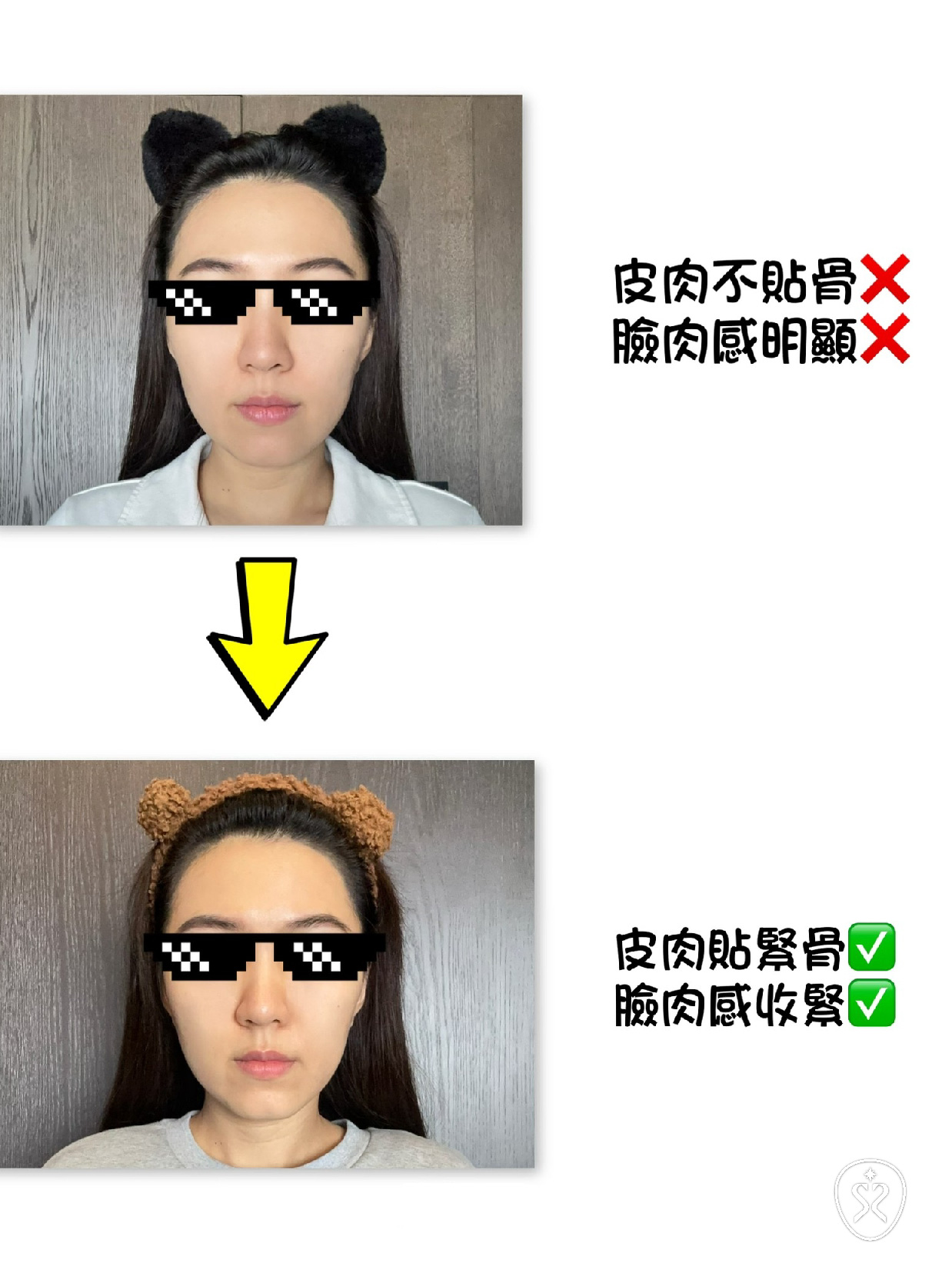 透過能量刺激真皮層的膠原蛋白增生，臉部更加緊緻有型